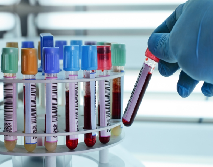 Xét nghiệm sinh hóa máu là gì